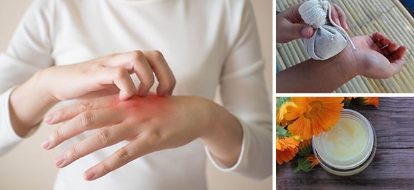 How To Treat Eczema Naturally The Lost Herbs 