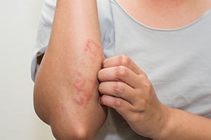 How To Treat Eczema Naturally