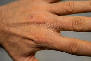 How To Treat Eczema Naturally