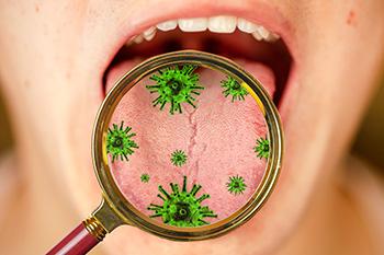 The Super Herb That Destroys Candida - What is Candida