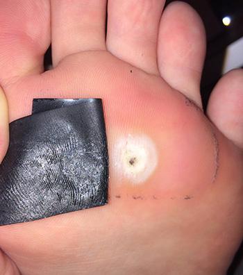 how to get rid of warts on fingers with duct tape