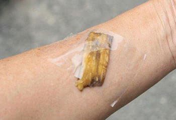 Don’t Throw Banana Peels, Do This Instead!- removing warts