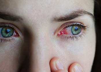 How to Treat Conjunctivitis Naturally- conjunctivitis eye