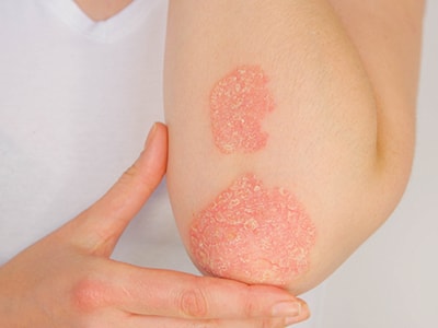 Homemade Oil for Psoriasis and Other Skin Issues - psoriasis rash