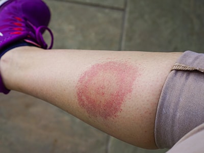 What To Do Immediately After A Tick Bite - tick bite rash