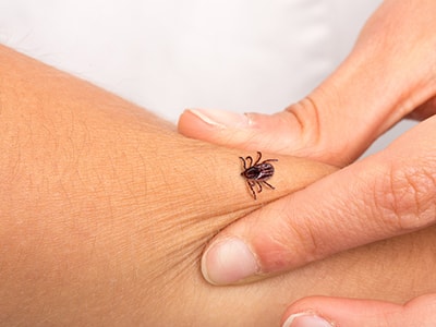 What To Do Immediately After A Tick Bite -tick