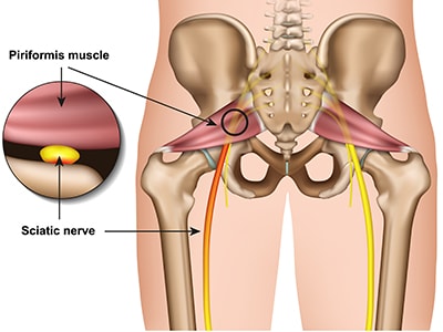 Ease Sciatic Nerve Pain With These Plants -Piriformis syndrome