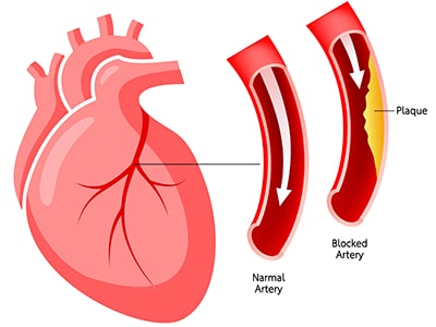 This Remedy Clears Clogged Arteries - coronary arthery disease