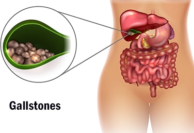 Gallstone Flush Routine - gallstones