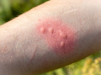 Red,Spot,And,Blisters,On,The,Arm,From,A,Nettle