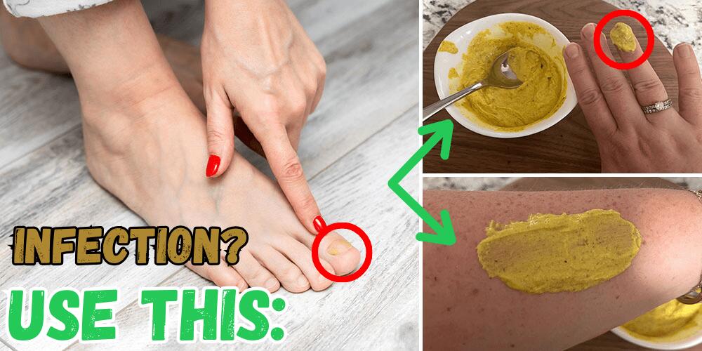 DIY Antifungal Poultice