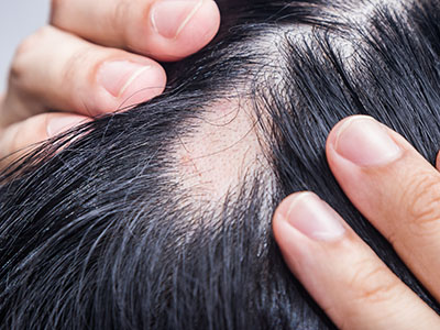 Alopecia,Areata,-,Spot,Baldness