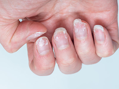 Flaky bitten and brittle nails without a manicure. Regrown nail cuticle and damaged nail plate after gel polish.