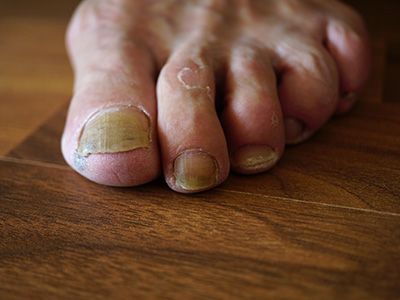 foot nail fungus wooden background close up - man showing yellow toenail fungal nails