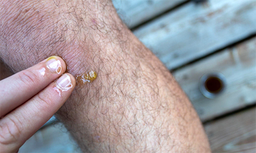 Anti-Eczema Plantain Oil - Step 4