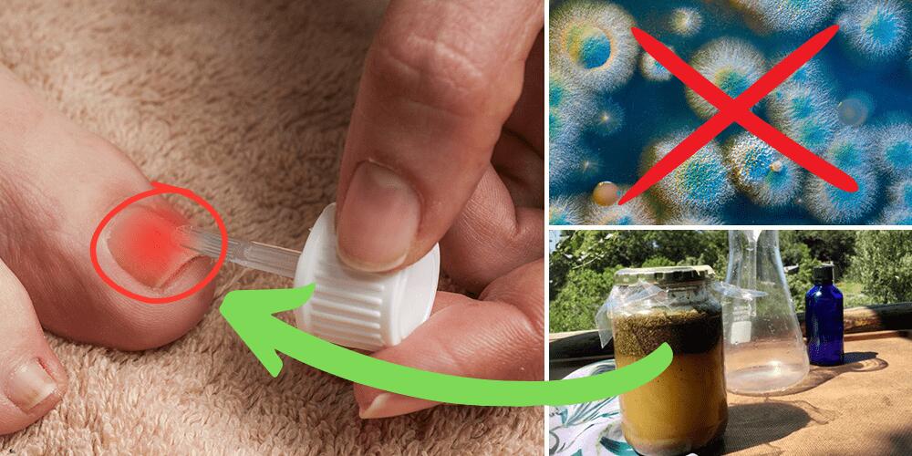 Inside and out remedy for toenail fungus