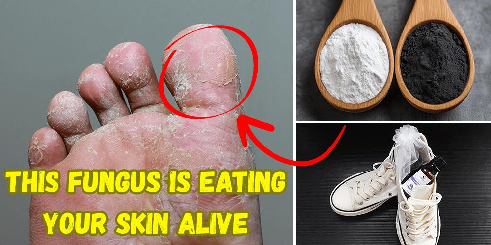This Fungus Is Eating Your Skin Alive