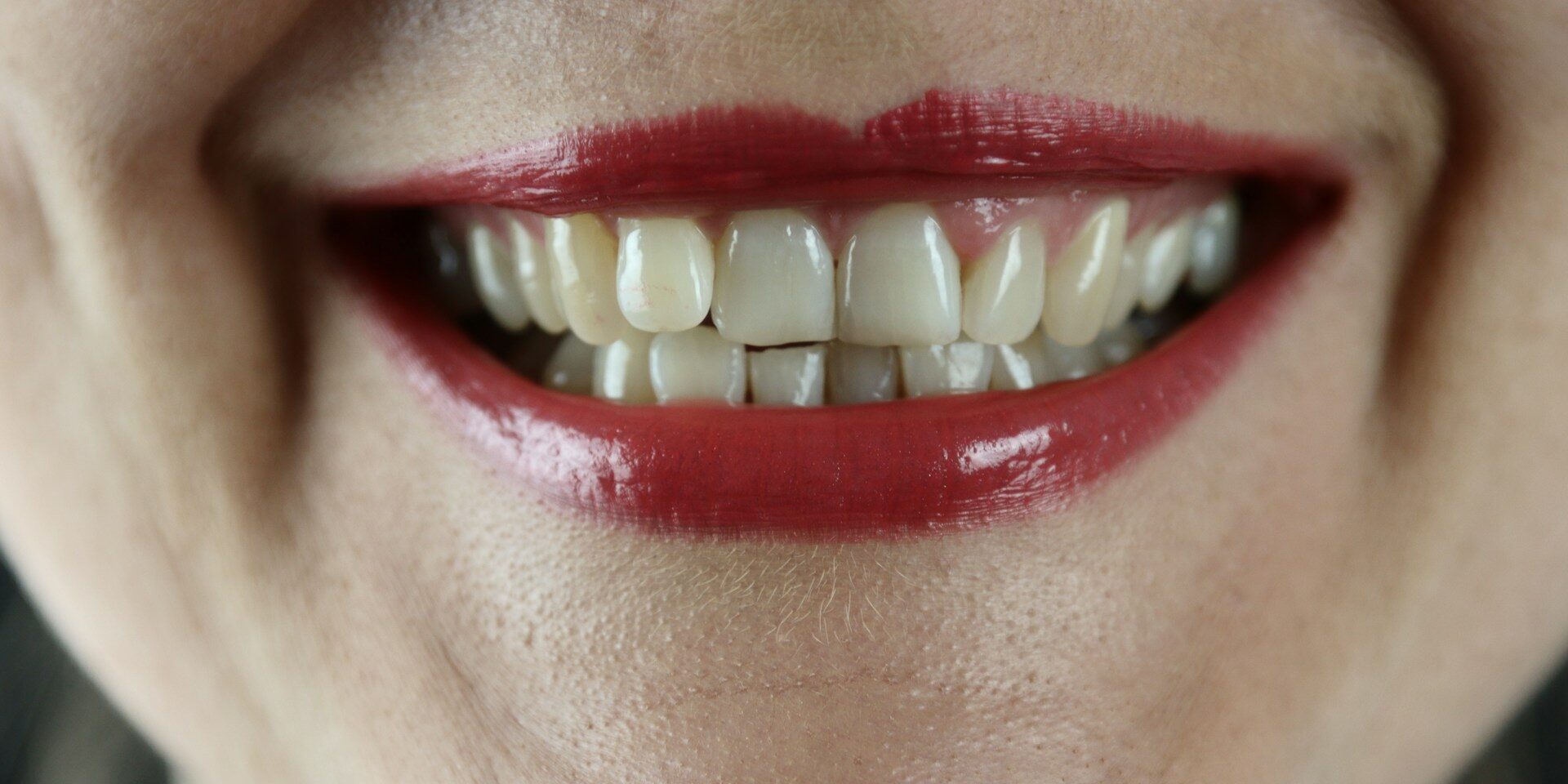 white teeth