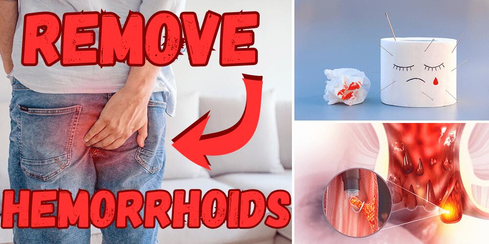 Hemorrhoid pain
