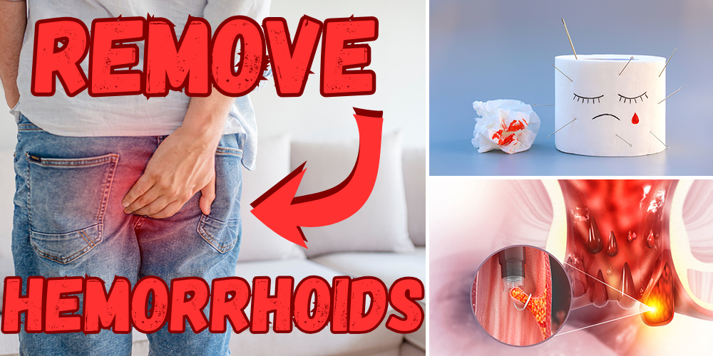 Hemorrhoid pain
