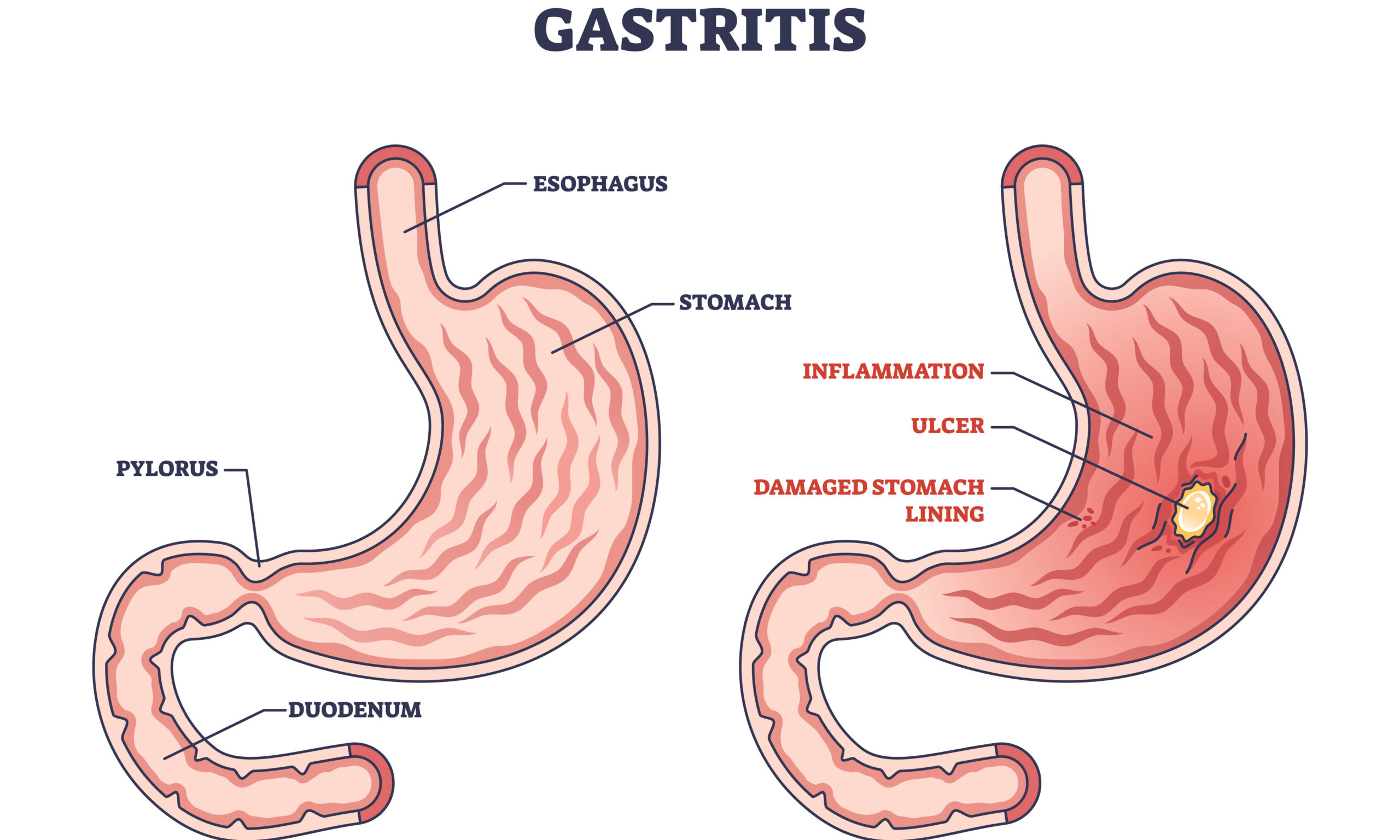 Gastritis as stomach lining inflammation illness and disease out