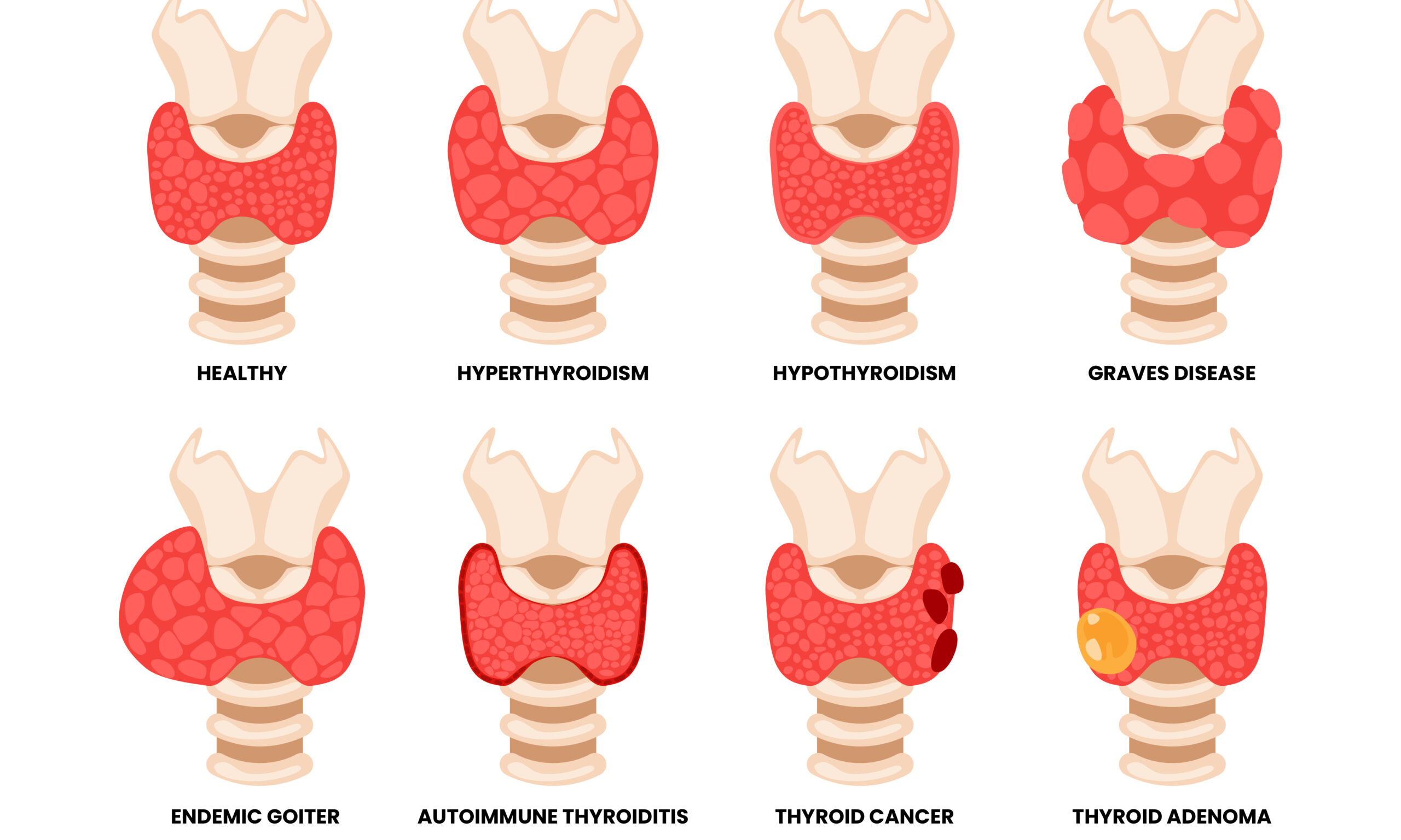 Different types of thyroid disease types, educational medical po