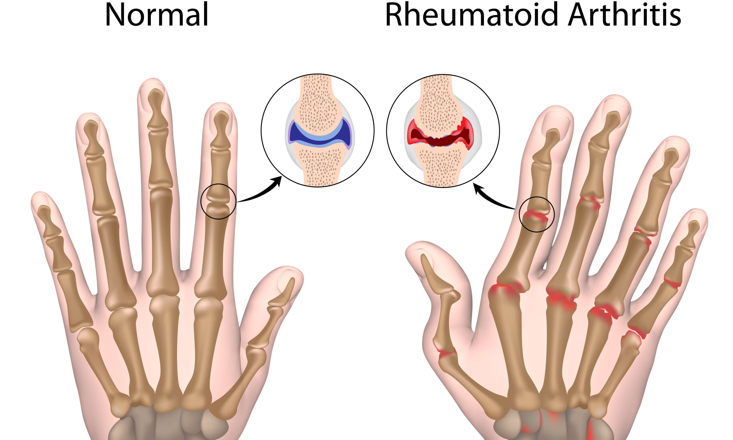 Rheumatoid arthritis of hand