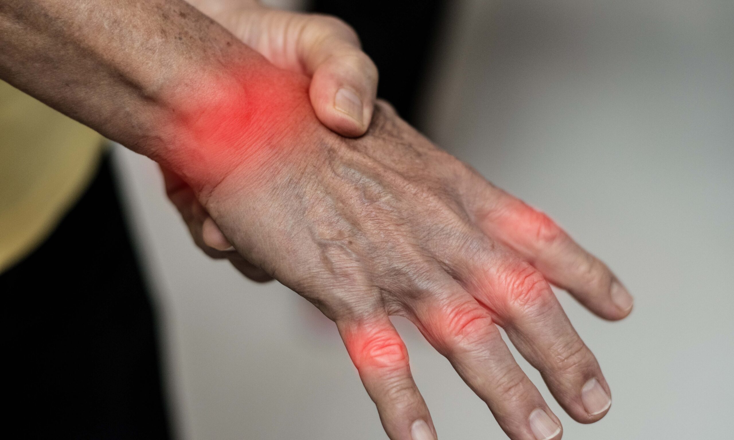 Overuse hand problems. Woman’s hand with red spot o fingers as suffer from Carpal tunnel syndrome. The symptoms of tingling, numbness, weakness, or pain of the fingers and wrist.
