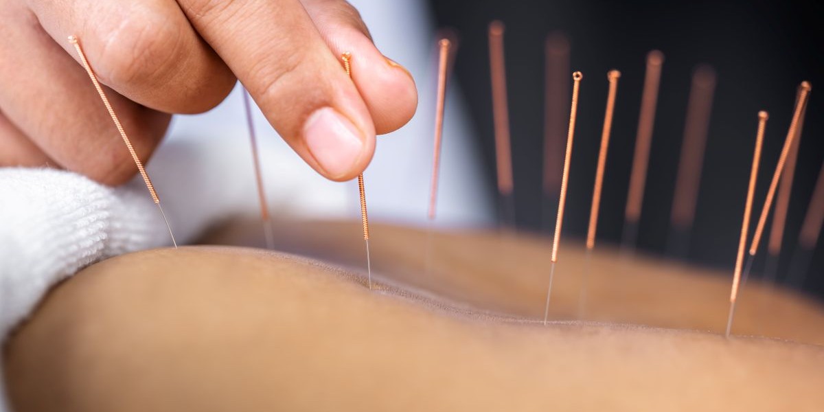 acupuncture