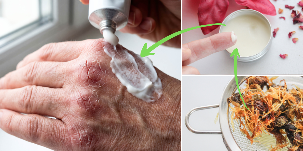 Herbal Skin Care for This winter