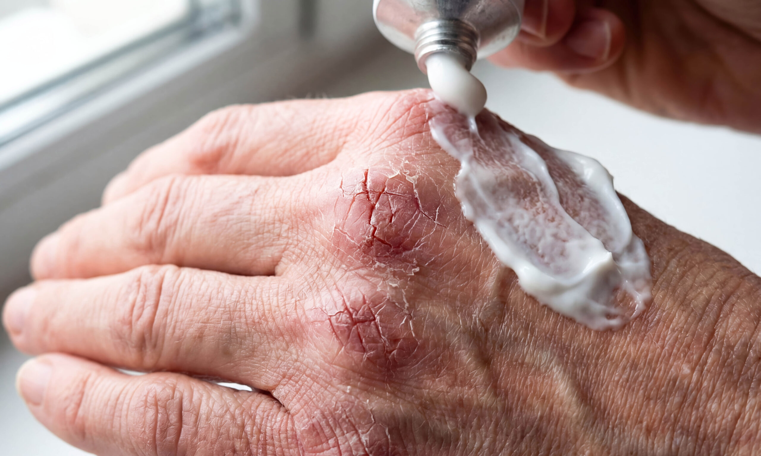 Dry cracked skin hands winter skincare dermatology problem cold