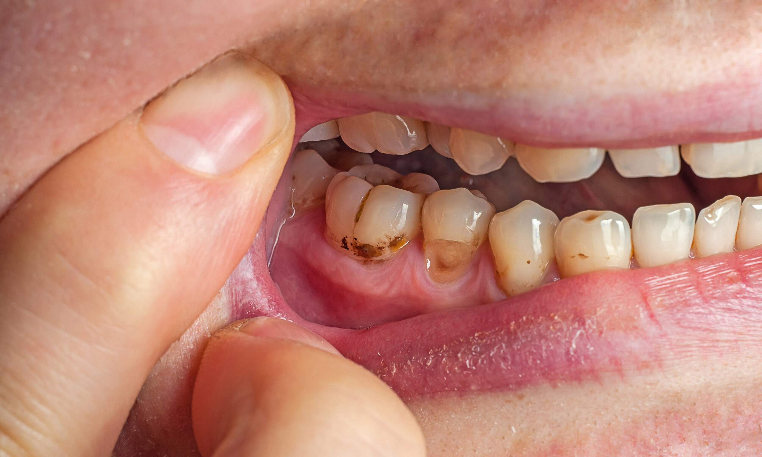 Yellow teeth with plaque close-up. The filling fell off the tooth