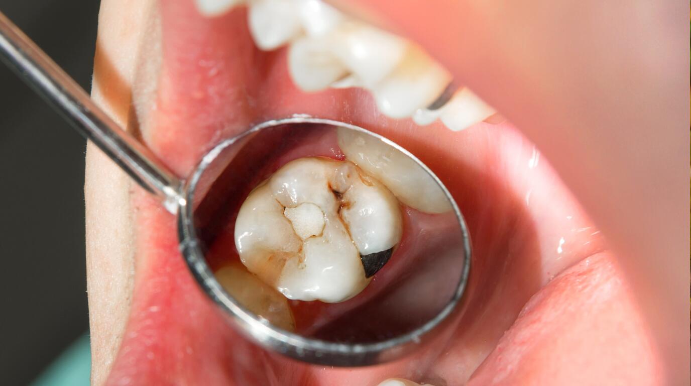 Cavity tooth