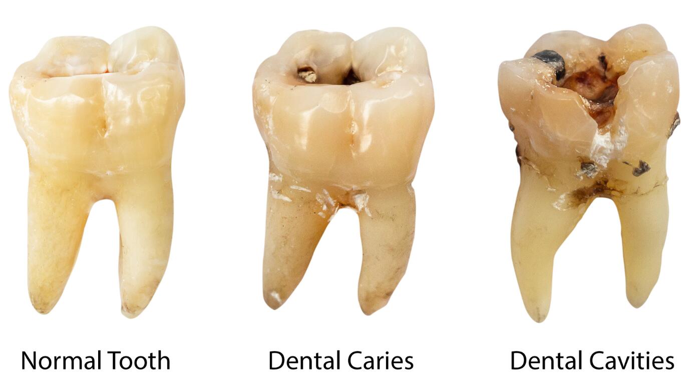 Tooth teeth issue