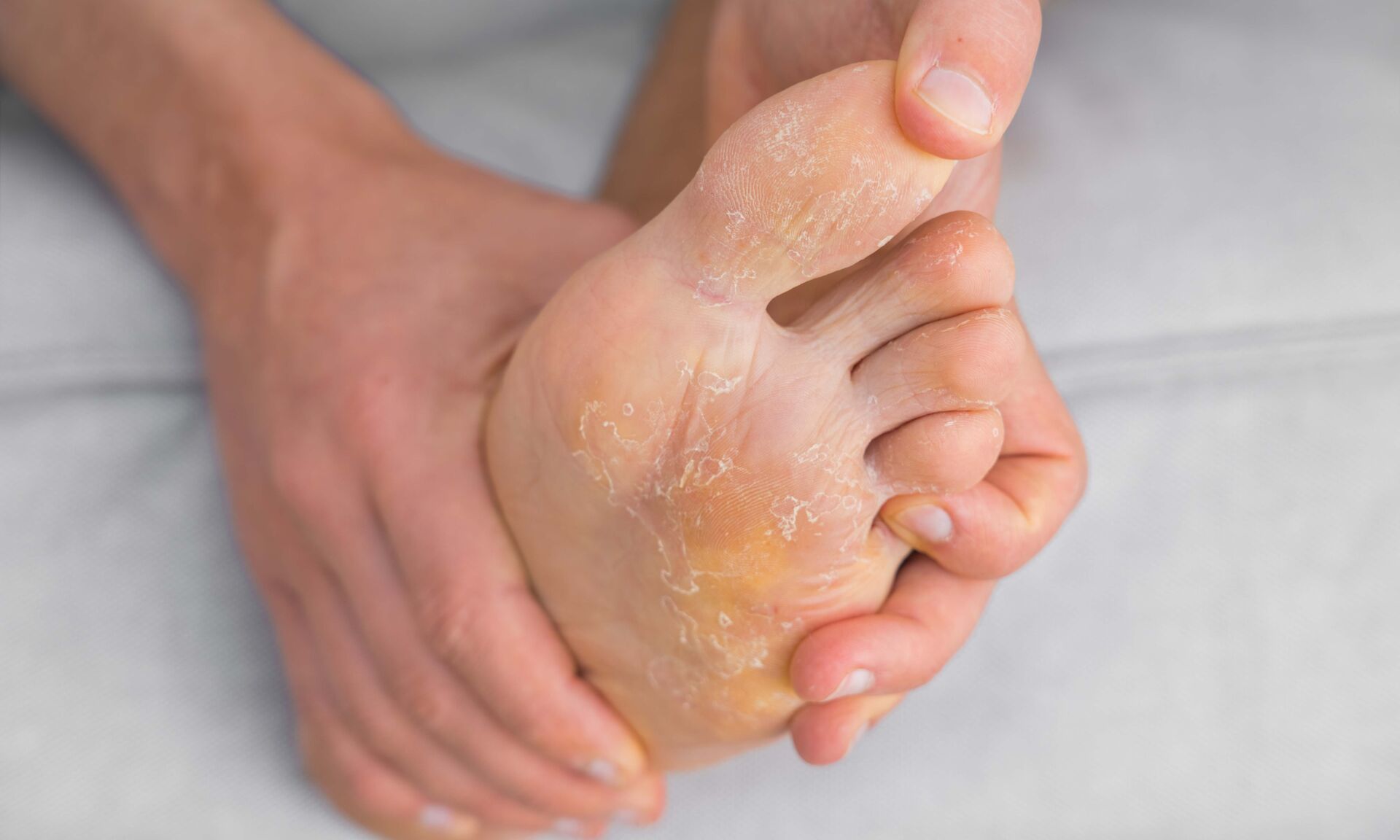Man with peeling and cracked feet. Fungal infection or athlete's foot, dry skin, dermatitis, eczema, psoriasis, sweaty feet or dehydration. Health care concept. High quality photo