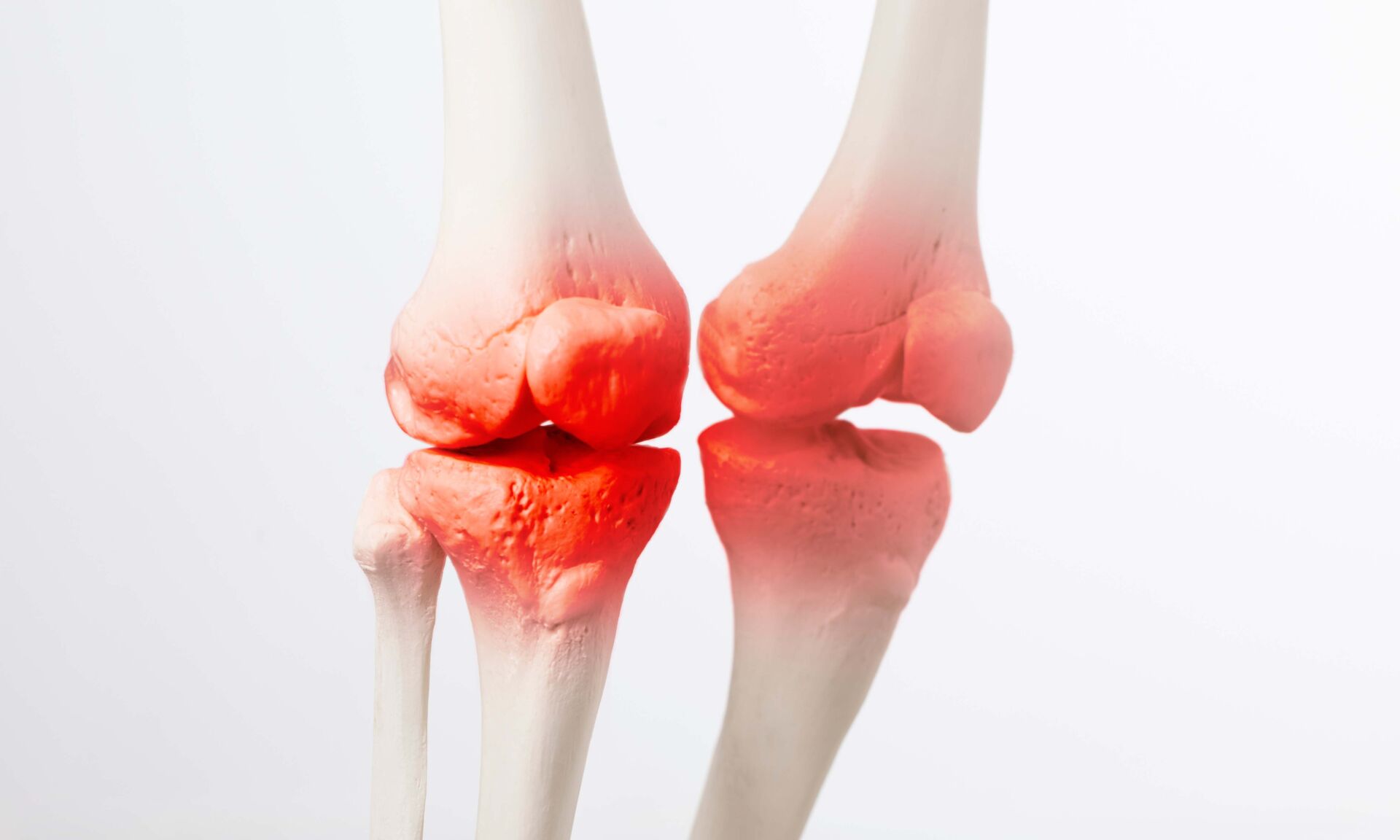 Knee meniscus inflamed, human leg, medically accurate representa