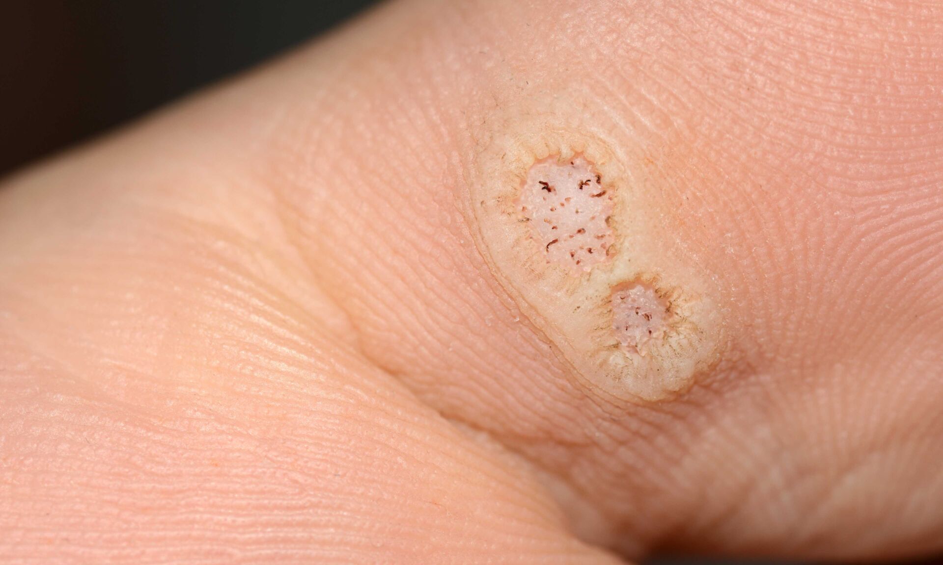 Closeup of two plantar warts on a toe caused by the human papill