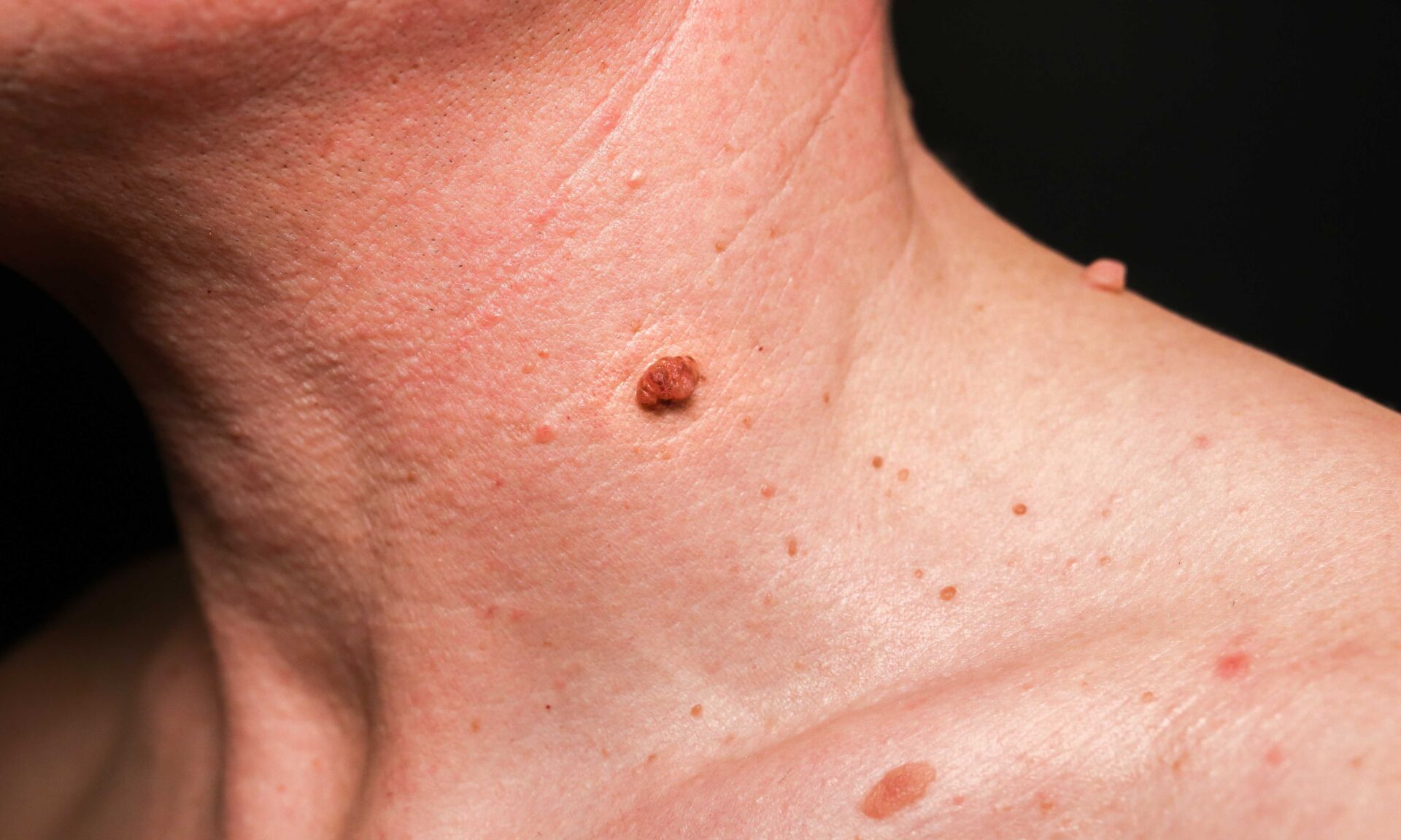 Big birthmark on the man's skin. Medical health photo. Papillomas on the neck.