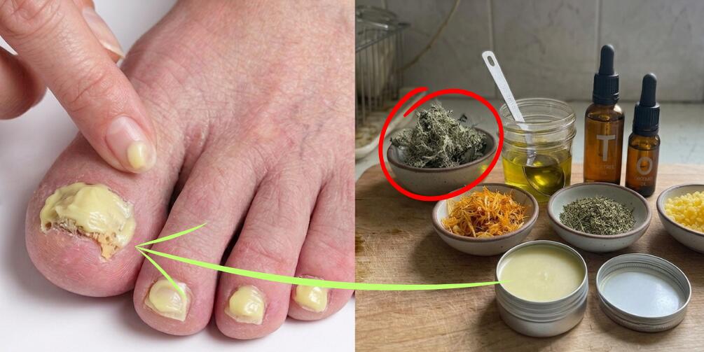 DIY Fungus-Killer Salve