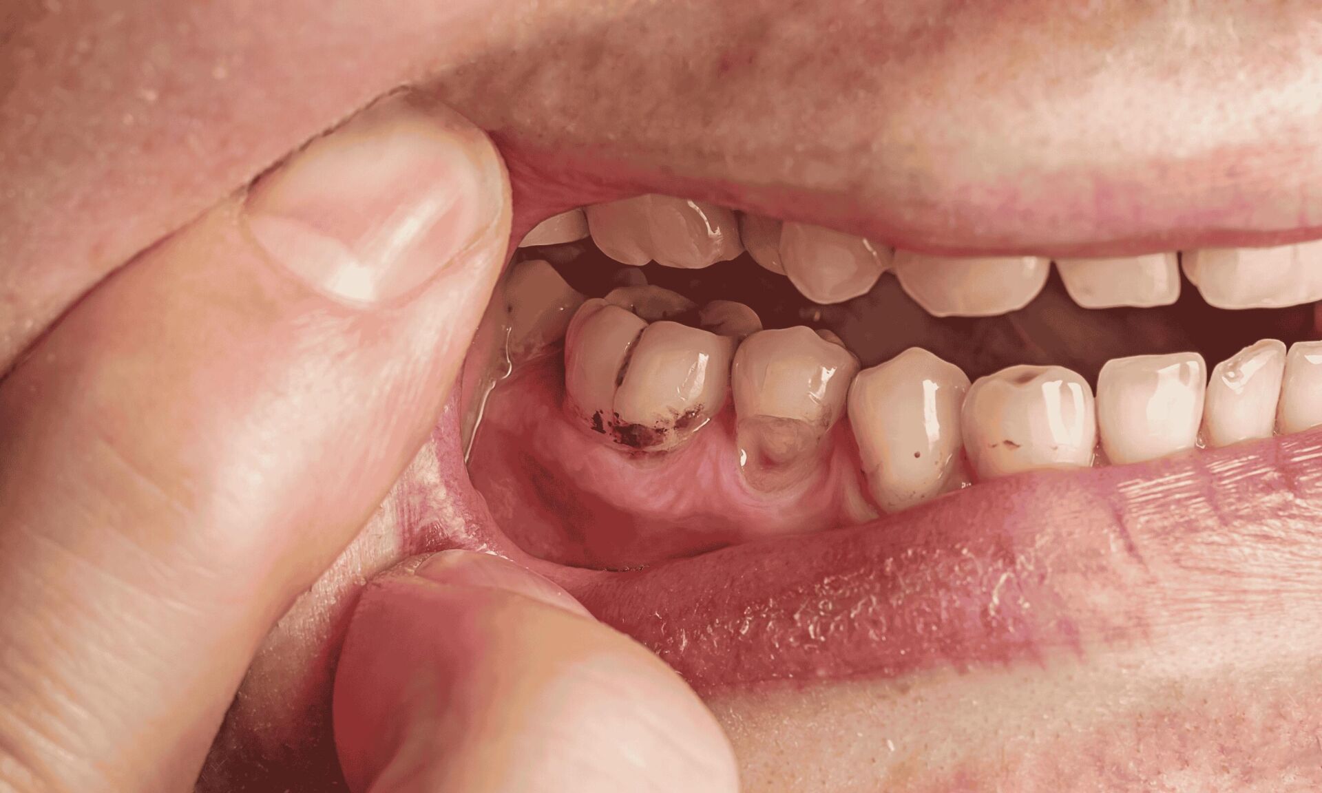 tooth decay