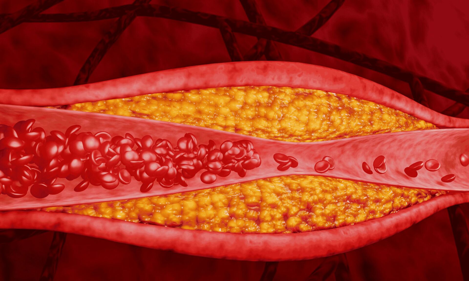 high cholesterol blocking arteries