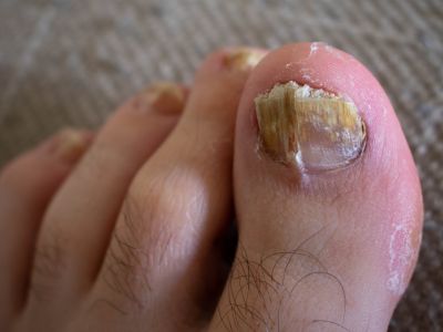 Toenail fungus