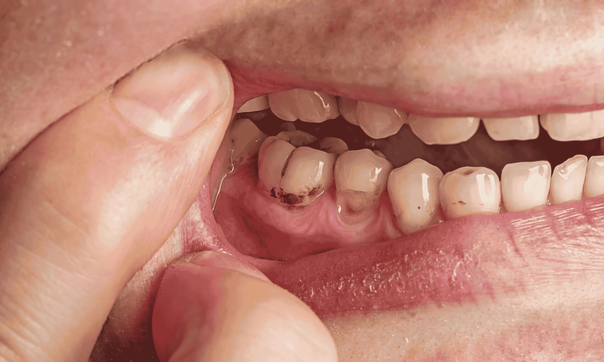 natures toothbrush for tooth decay
